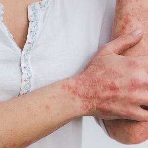 Study Finds Spesolimab Helps Prevent Generalized Pustular Psoriasis Flares